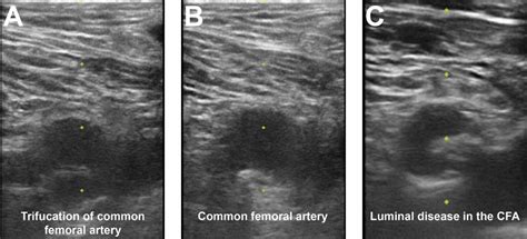 Femoral Artery Ultrasound