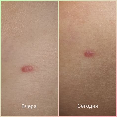 После удаления родинки появилась припухлость - Вопрос онкологу - 03 Онлайн