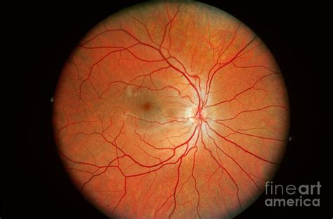 Normal Retina Photograph by Science Source - Pixels