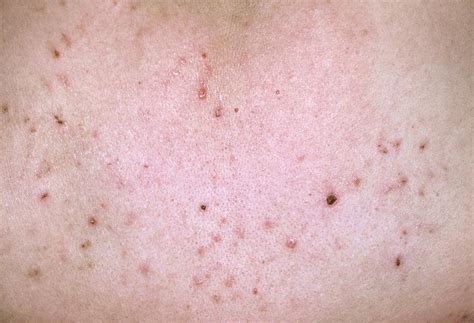 Pityriasis Lichenoides Spots On Skin Photograph By Dr P Marazzi