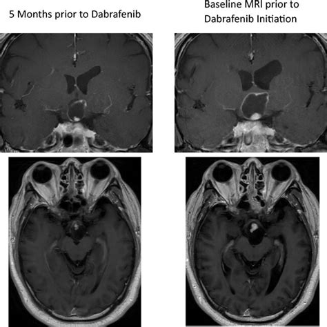 Pretreatment Tumor Growth Of The Cyst And Mural Nodule This Figure