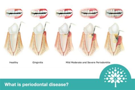 What Is Periodontal Disease Oakley Road Dental Practice