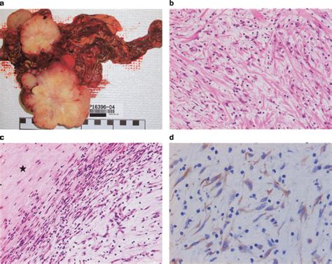 Histopathologic appearance. (a) Surgical specimen showing omentum with... | Download Scientific ...