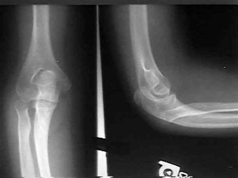 Congenital Dislocation Of Radial Head Wheeless Textbook Of Orthopaedics