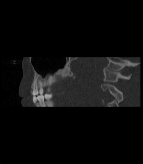 Filepalatal Maxillary Canine Impaction Peg Shaped Lateral Incisor