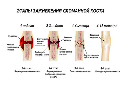 Как сделать фиктивный перелом