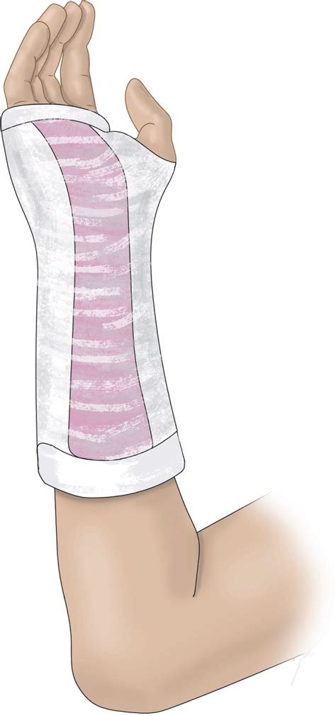 Volar Splint