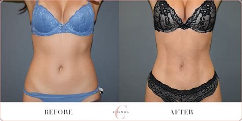 Female Vaser Hi Definition Liposuction Before After