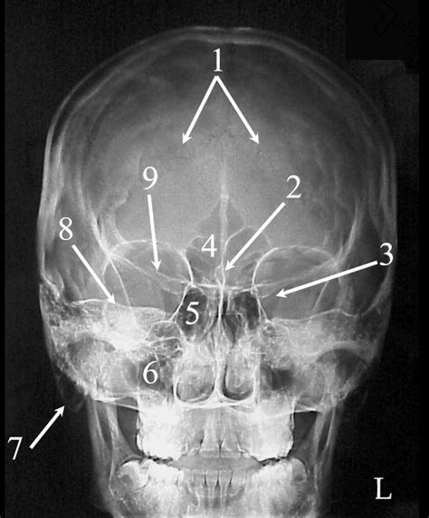 Pa Caldwell Skull Diagram Quizlet