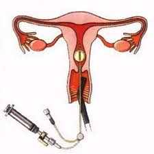 How does a sonohysterogram help in assessing female fertility?