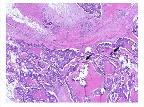 Ascending Colon Biopsy Moderately Differentiated Adenocarcinoma In Download Scientific