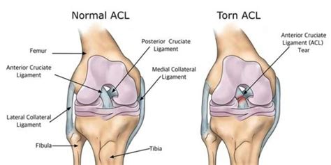 Acl Injury Definition Symptoms Causes Risk Factors Complication Test And Diagnosis