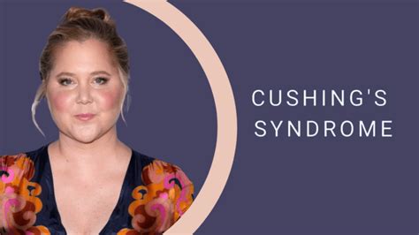 Cushing Syndrome What You Need To Know Jupiter Fl Doctors