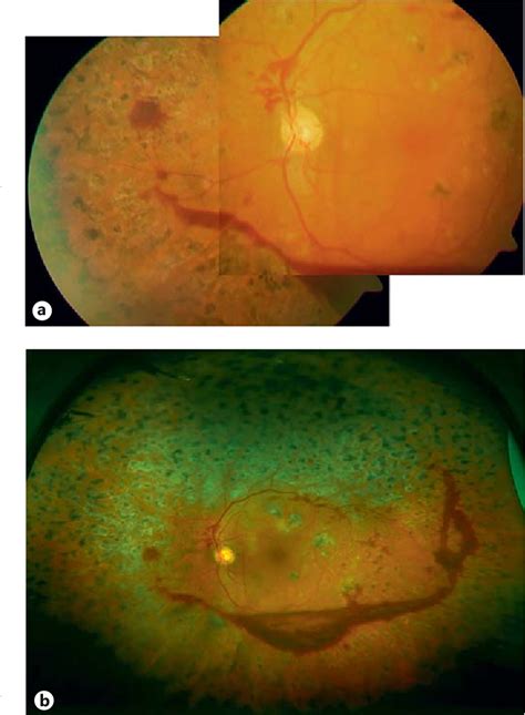 Figure 1 From Nonmydriatic Ultra Wide Field Scanning Laser Ophthalmoscopy Optomap Versus Two