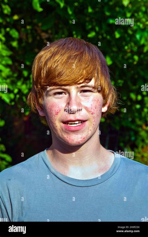 portrait  cute boy  puberty  acne stock photo alamy