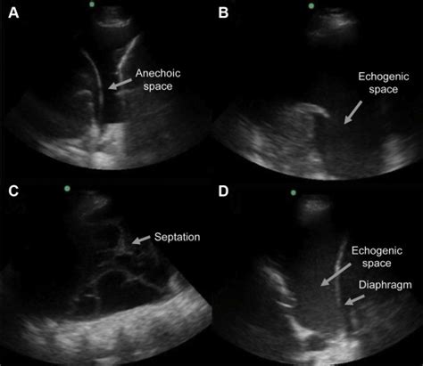 Pleural Effusion Ultrasound