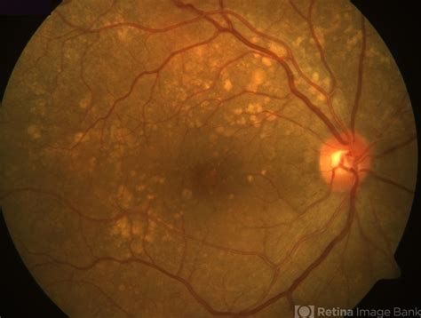 Dry Age Related Macular Degeneration Fundus Photograph Retina Image Bank