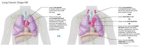 Lung Cancer Staging Lungevity Foundation