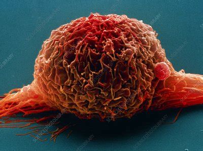 Bladder Cancer Cell SEM Stock Image M132 0648 Science Photo Library