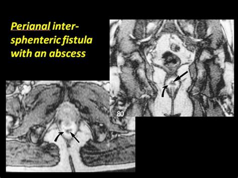 Presentation Pptx Peri Anal Fistula PPTX Digestive Disorders Diseases And Conditions