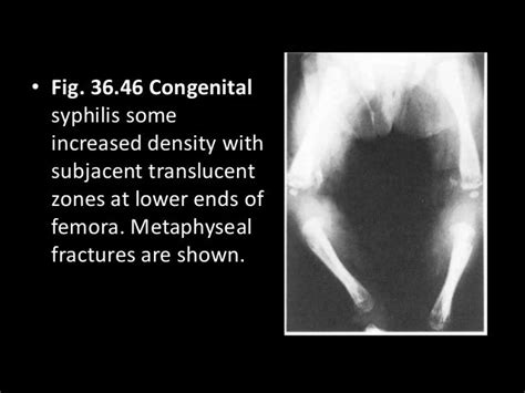 36 David Sutton Pictures Periosteal Reaction Bone And Joint Infection