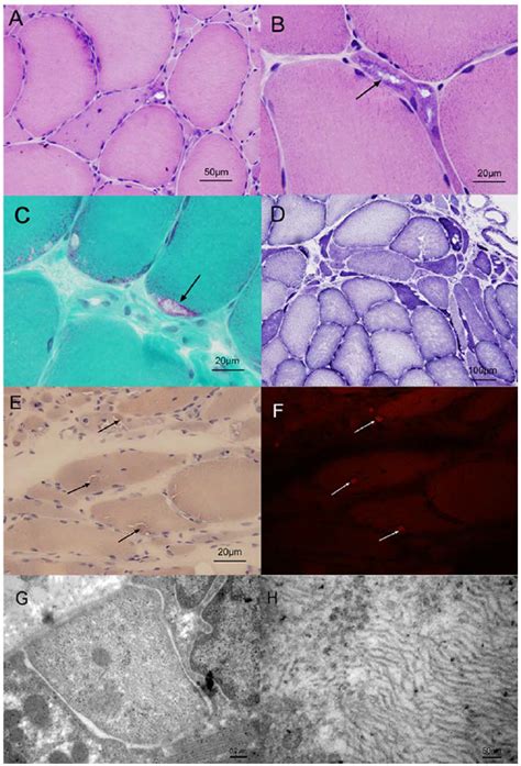 Serial Sections Of A Muscle Biopsy Obtained From The Left Quadriceps