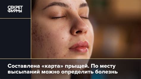 Прыщи на лице: как от них избавиться: Новости — Секрет фирмы