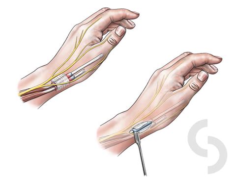 Picture 1 A Anatomy Of The 1st Extensor Compartment In The Wrist