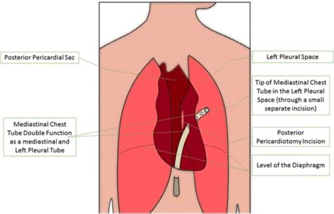 Double Function Of The Mediastinal Chest Tube In Posterior