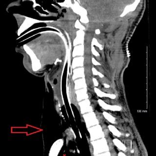 Computed Tomography Scan Of The Neck Sagittal Section Showing