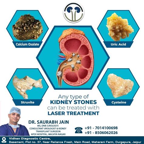 Efficient Kidney Stone Laser Treatment for Quick Relief | Expert Insights!