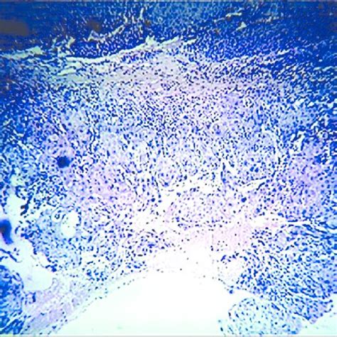 Low Power Photomicrograph Showing Presence Of Actively Proliferating