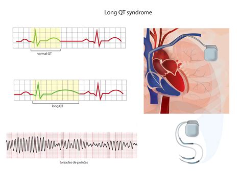 Long QT Syndrome | Progenics