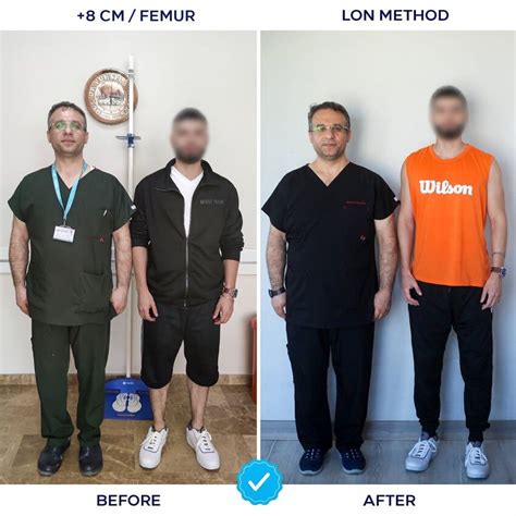 Leg Lengthening In Turkey Prices And Procedures