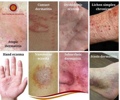 Atopic Dermatitis (eczema)