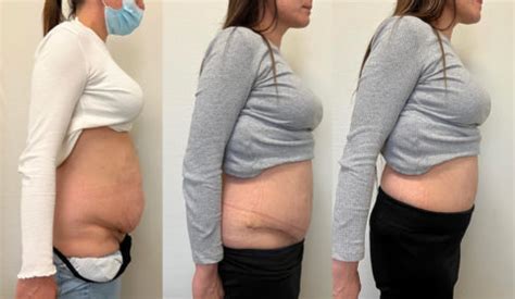 Abdominoplastie après chirurgie bariatrique Centre de Chirurgie