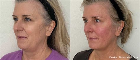 Evoke RF Skin Tightening CNY Syracuse NY