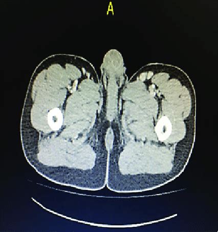 Bilateral Inguinal Lymphadenopathy