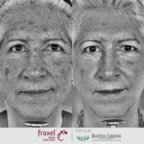 Vancouver Fraxel Dual Laser In Surrey Skin Tone Anti Aging