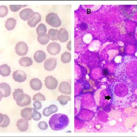 Peripheral Blood Smear And Bone Marrow Photomicrograph Showing A