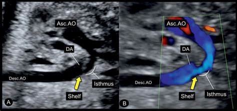 Coarctation Of The Aorta And Interrupted Aortic Arch Obgyn Key