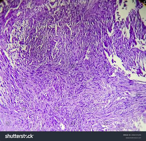 Photomicrograph Malignant Peripheral Nerve Sheath Tumor Stock Photo