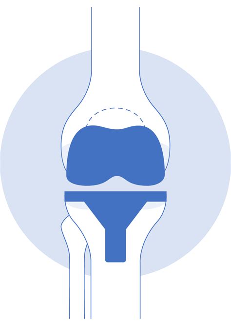 Total Knee Replacement Sven Putnis