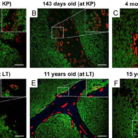 Duct-like structures consist of SOX9+HepPar1+ cells in BA patients of ...