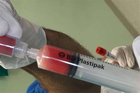 Infiltraciones De Plasma Rico En Plaquetas Y C Lulas Madre Un