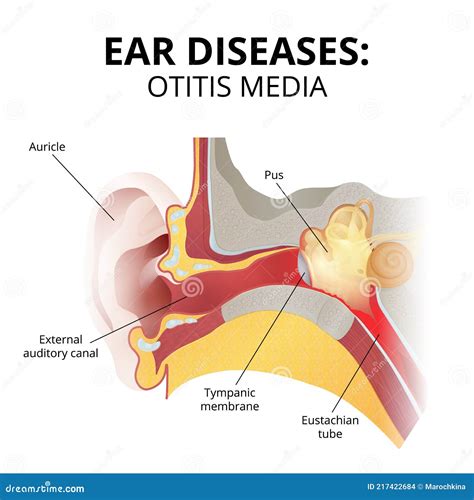 Set Symptoms Of Otitis Cartoon Vector | CartoonDealer.com #190621991