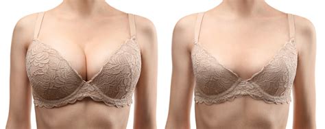 Womens Breast Reduction Cost Photos Procedure More Flawless