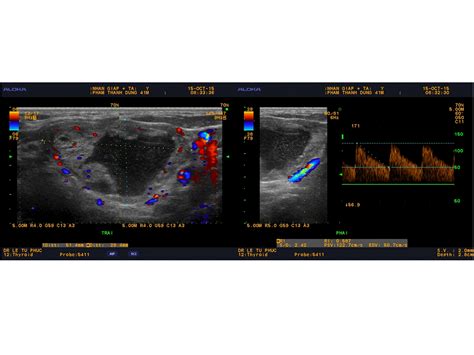 Vietnamese Medic Ultrasound Case 341 Thyroid Toxic Adenoma Dr LÊ TỰ