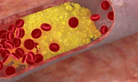 Народні кошти від підвищеного холестерину