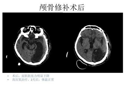 颅脑外伤术后阵发性交感神经过度兴奋综合征 颅脑创伤 神经重症病例周刊（139期） 脑医汇 神外资讯 神介资讯